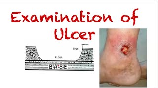 Examination of Ulcer  A guide for surgical case evaluation [upl. by Bove429]