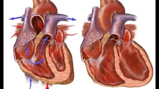 Congestive Heart Failure [upl. by Bashuk]