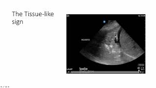 Lung Ultrasound Alveolar Consolidation  Shred Sign [upl. by Attenauq765]