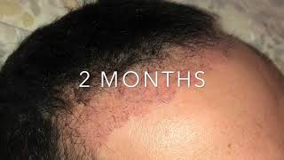 Trapianto Capelli Giorno per Giorno da giorno 1 a 6 mesi  Hair transplant Day By Day [upl. by Dela]