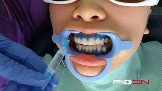 Teeth Whitening Bleaching [upl. by Ause371]