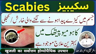 Scabies شدید خارش اور کھجلی शरीर में कीड़ों से खुजली होना Homeopathic Treatment In Urdu  Hindi [upl. by Casavant]