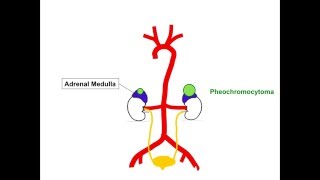 Pheochromocytoma causespathophysiologysymptoms and treatment [upl. by Wylde202]