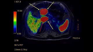 Are Neuroendocrine Tumors always cancerous  Apollo Hospitals [upl. by Ahsinrats226]