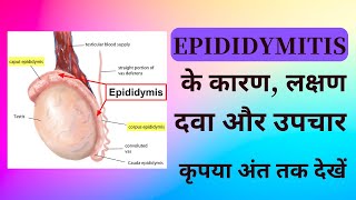 Epididymitis Symptoms in Hindi  Epididymitis Causes  Epididymitis Treatment in Hindi  Dr Ramdeo [upl. by Karab818]