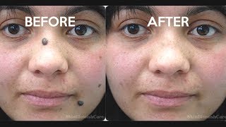 2 Easy Ways To Remove Moles From Your Face  How To Get Rid Of Moles [upl. by Coletta]