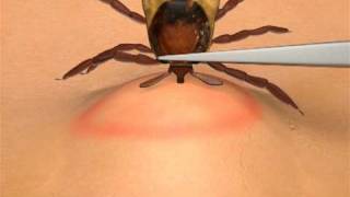 How To Remove A Tick [upl. by Licht]