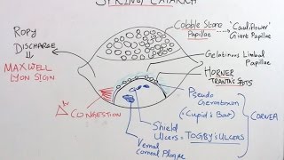 High Yield Topic Vernal Kerato Conjunctivitis amp Trachoma [upl. by Garnet252]