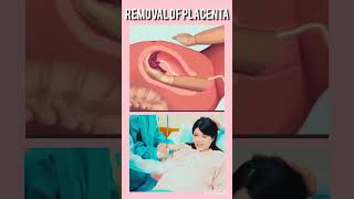 Removal of placenta fetalmovement bodypart baby cutebaby shorts [upl. by Ayetal671]