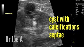 Bosniak grade 2F renal cyst ultrasound and color Doppler imaging [upl. by Kessia]