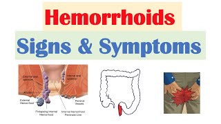 Hemorrhoids Signs amp Symptoms  Internal vs External Hemorrhoid Symptoms  Hemorrhoidal Disease [upl. by Foote]