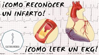 COMO RECONOCER UN INFARTO EN EL EKGECG EKG PARTE 7 [upl. by Sontag]