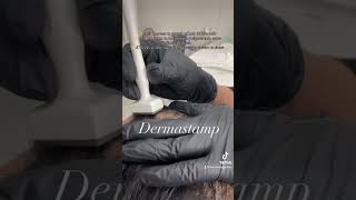 DermaStamp or microneedling for hair loss [upl. by Westland]