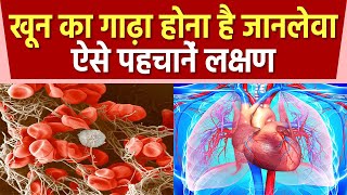 Blood के गाढ़ा होने से Health को होते है गंभीर नुकसान जानिए लक्षण और ब्लड पतला करने के उपाय [upl. by Melvyn]