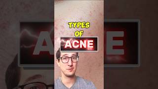 Types of Acne Explained and HOW to Treat It [upl. by Wilton183]