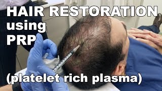 Scalp psoriasisSymptom Cause Treatment  Safe ways to Wash Hair Dr Rasya Dixit Doctors Circle [upl. by Claus]