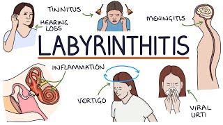 Understanding Labyrinthitis [upl. by Maryl850]