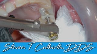 Loose Implant Screw  Dental Minute with Steven T Cutbirth DDS [upl. by Yenahpets]