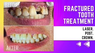 Laser Tooth Repair Watch How I Fixed A Broken Tooth With Post And Crown Placement [upl. by Elston521]