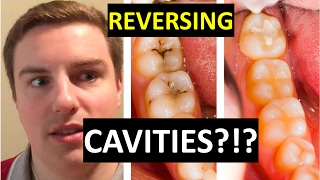 CAN YOU CURE CAVITIES AT HOME [upl. by Adnilreh]