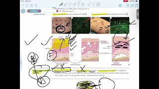 EPIDERMOLYSIS BULLOSA SIMPLEX [upl. by Naeloj]