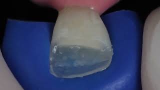 Composite bonding and tooth reconstruction using IPS Empress Direct from Ivoclar [upl. by Land]