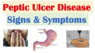 Peptic Ulcer Disease Signs amp Symptoms  Gastric vs Duodenal Ulcers [upl. by Lombardy]