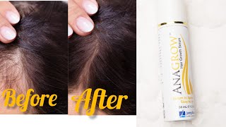 anagrow hair serum jenpharm best hair fall serum ever must try [upl. by Eicart]