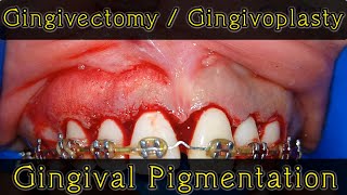 gingival pigmentation  gingivectomy  gingivoplasty 牙龈切除术 case7 [upl. by Ordnassela]