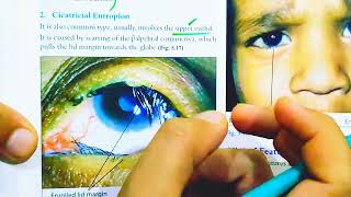 Entropion  Treatment of Entropion  Causes of entropion  Entropion and Ectropion Eye lectures [upl. by Hawkins]