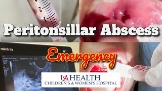 Peritonsillar Abscess Emergency and Needle Aspiration [upl. by Adnilemreh]