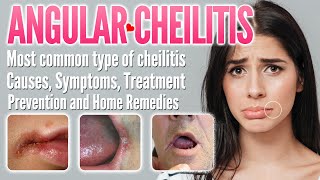 Angular Cheilitis Causes Symptoms Treatment Prevention and Home Remedies  Perleche Stomatitis [upl. by Llenil]