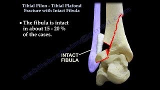 Tibial Pilon Fracture With Intact Fibula  Everything You Need To Know  Dr Nabil Ebraheim [upl. by Marigold]