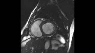 Cardiac MRI  Short axis view with tricuspid amp mitral valve [upl. by Simara63]