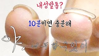 내성발톱 교정 2탄 내성발톱 자가치료 무편집 10분👍👍 야 너두 내성발톱 자가치료 쉽게 할 수 있어 [upl. by Ymerrej]