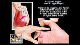 ONE Exercise to FIX Gamers Thumb Mommys Thumb [upl. by Megen]