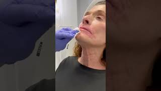 Botox for platysmal bands in the neck [upl. by Raual]