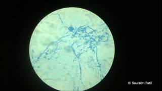 Trichophyton rubrum Lactophenol cotton blue mount [upl. by Drusilla]