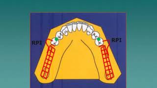 Diseño de Prótesis Parcial Removible [upl. by Aloysia278]