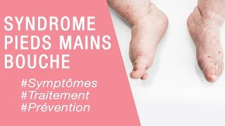 Le syndrome pieds mains bouche  Maladies infantiles [upl. by Oakes]