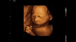 23 Week Old Baby  3D 4D Ultrasound New Jersey [upl. by Argile]