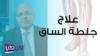 طرق علاج جلطة الساق [upl. by Bolton]