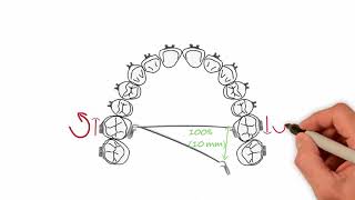 Transpalatal Arch Activations  Essential Biomechanics [upl. by Dominick]