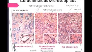 Carcinoma de mama descripción patológica [upl. by Oruntha]