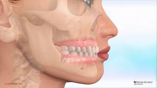 Carriere® Clear Motion™ Class II Appliance  Maxillary hypoplasia [upl. by Evangeline]