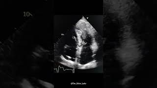 Aneurysmal apex 💔 echocardiogram echocardiography cardiology heartscan Aneurysm [upl. by Yuhas840]