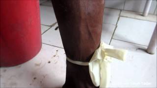 Multiple Tourniquet Test For Varicose Vein [upl. by Yelknirb260]