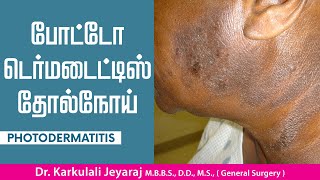 போட்டோ டெர்மடைட்டிஸ்  Photodermatitis Skin Diseases Treatment and Details  TAMIL JKT SKIN CARE [upl. by Griseldis]