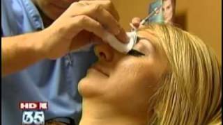 Dr Roger Bassin uses Restylane for Non Surgical Nose Job [upl. by Kawasaki]