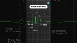 Hyperkalemia and Hypokalemia ECG changes [upl. by Akinak863]